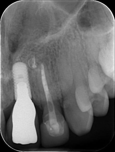 Radiographic (A) and clinical (B) presentation two years after dental implant insertion in the region of the left maxillary central incisor.