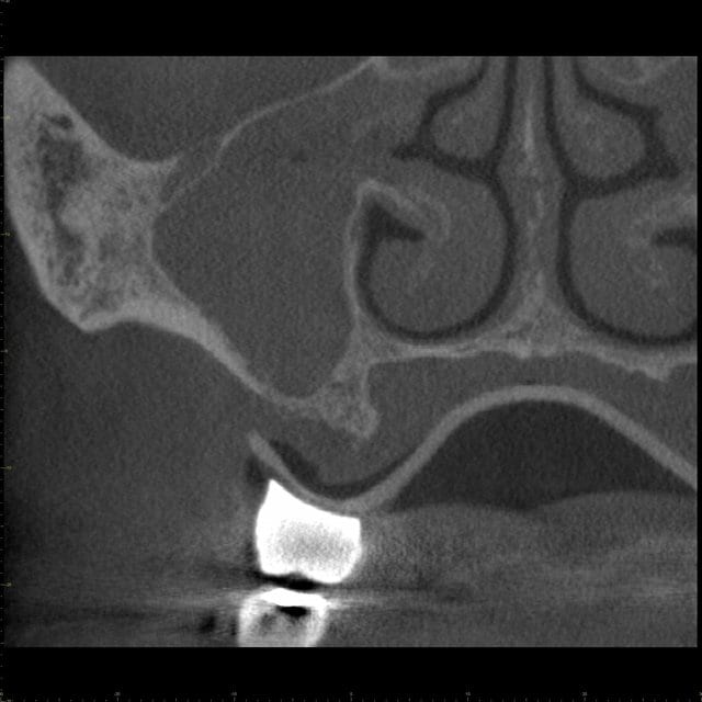 Coronal CBCT image, first molar region