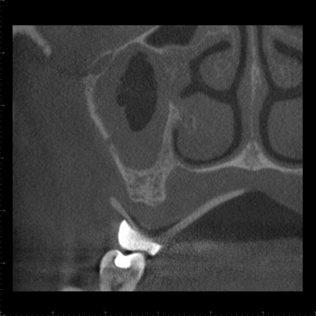 Coronal CBCT image, second molar region