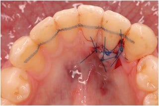 Fig. 11: Intraoral photo taken with mirror by Dr. Gernhardt ZZMK Halle – status after the gingiva defect on 32 was covered