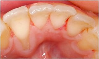 Fig. 4: Intraoral photo, lingual, after removal of the bonded retainer 33-43 – recession on the gingiva by about 4 mm