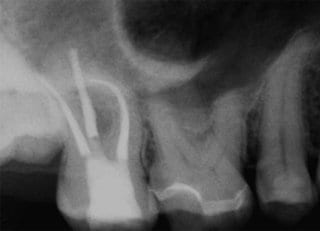Fig. 5: Tooth 17 after endodontic treatment