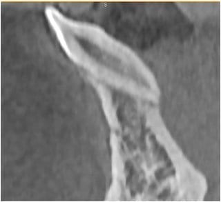 Fig. 6: Image generated from CBCT scan – tooth 32 markedly tilted, the lingual surface and root apex are not covered by bone
