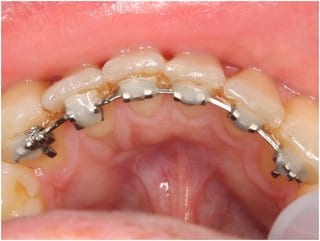 Fig. 7: Intraoral photo taken at the end of the active treatment – multi-bracket system (2D plus – Forestadent) fixed with low-viscosity composite filling