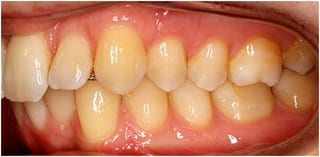 Fig. 3: Intraoral photo left – neutrocclusion, retainer between 13 and 12 visible