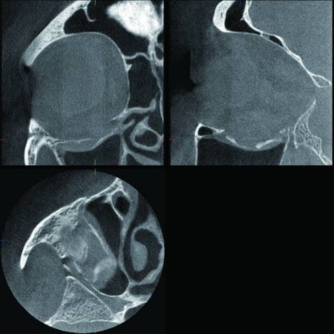 Blow-out fracture with fracture of the orbital cavity base.