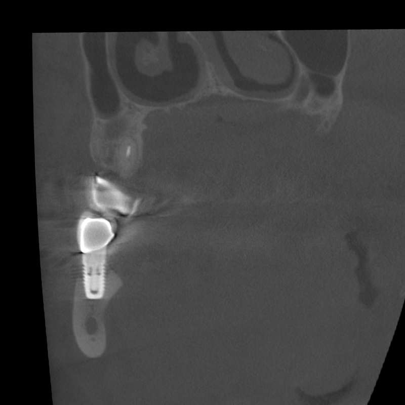 CBCT implantology upper and lower jaw periimplantitis