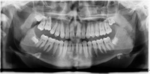 Vom überweisenden Kieferorthopäden gestelltes OPG zeigt den Ausgangsbefund „Infraposition Zahn 16.“