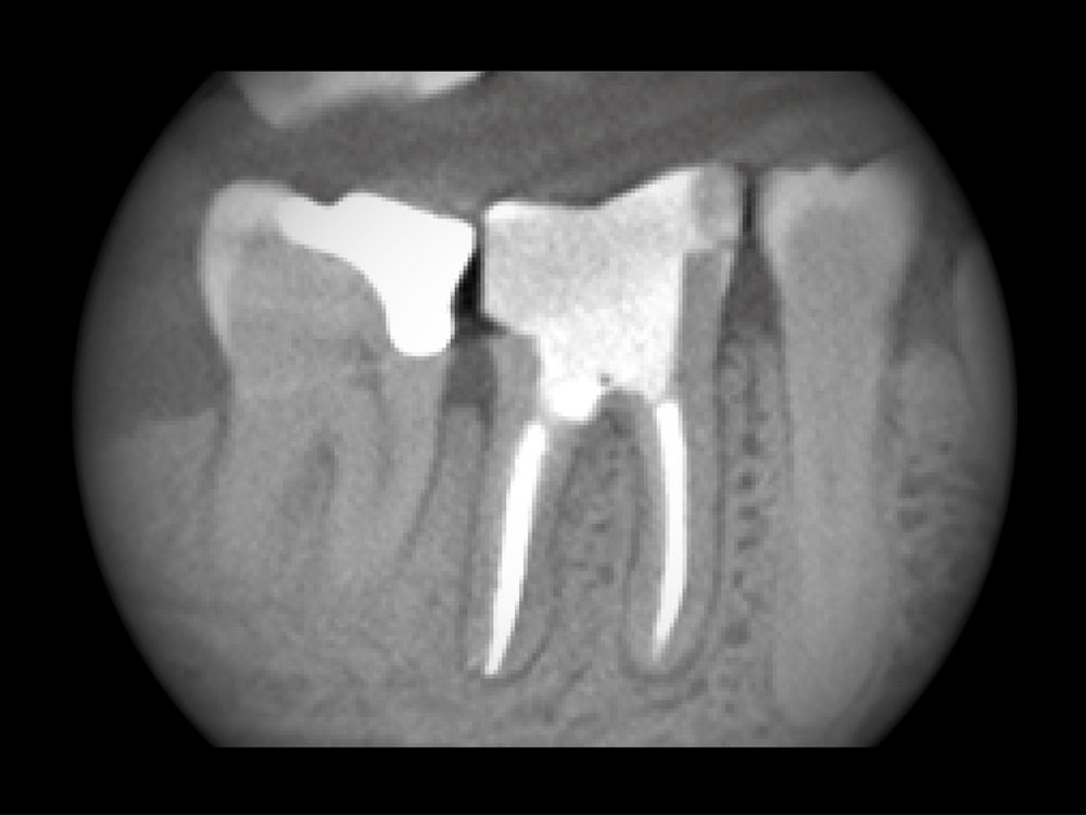 Digitales - dentales Roentgen - Endodontie 1