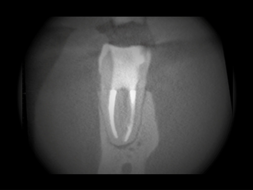 Digitales - dentales Roentgen - Endodontie 2