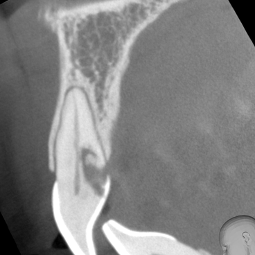 Endodontie Wurzelkanal Röntgen DVT Aufnahme 