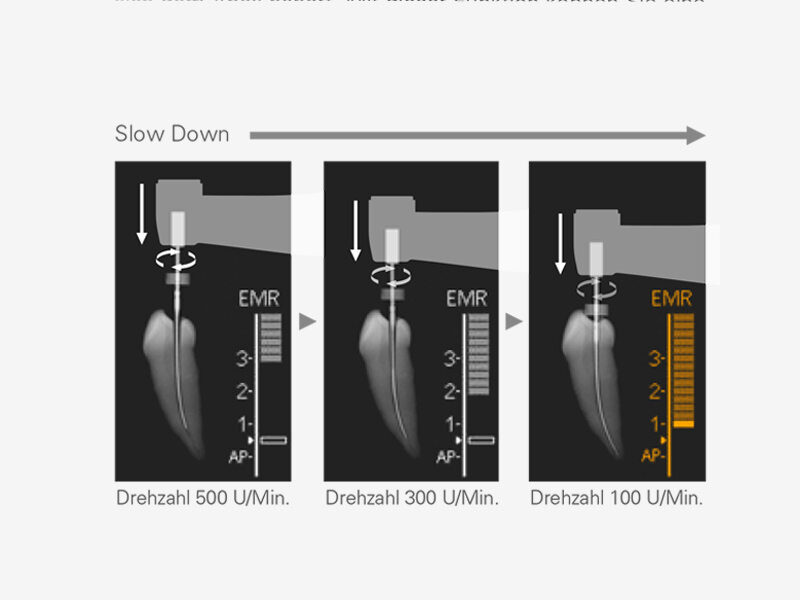 Apical Slow Down reduziert Rotationsgeschwindigkeit der Feile