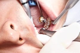 Trattamento di carie sul dente 46