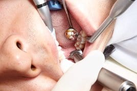 Trepanación del diente 17